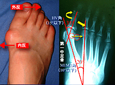 外反母趾 がいはんぼし の症状と治療 手術療法 横浜の吉野整形外科